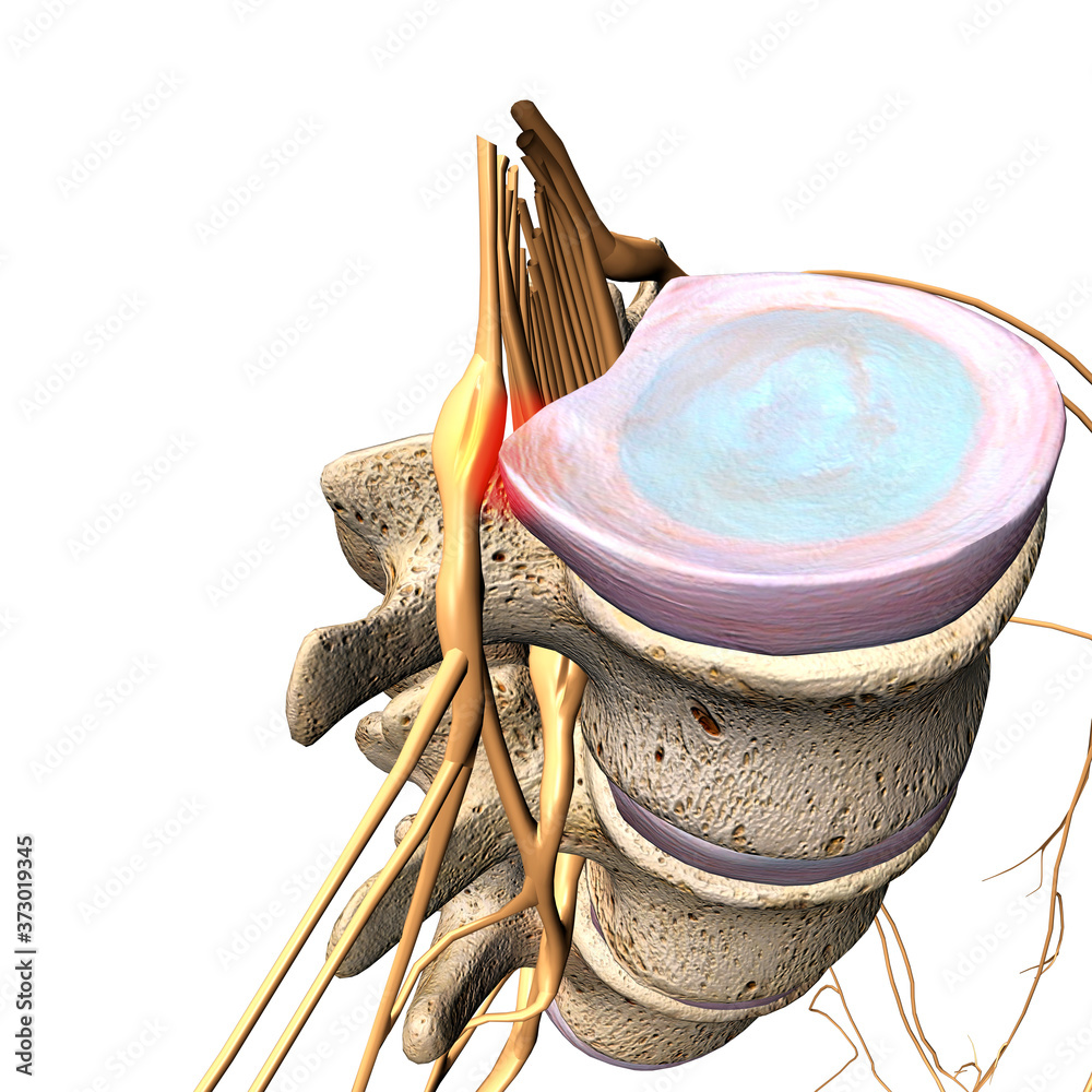 Herniated Disc Pressing Against a Spinal Nerve on White Background