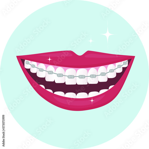 Human smile with wide open white and straight teeth with braces. Dental service - Orthodontics treatment and straightening of teeth. Flat vector illustration
