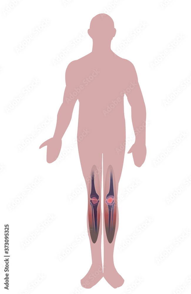 Male illustration and knee cartilage image Male illustration and knee cartilage image