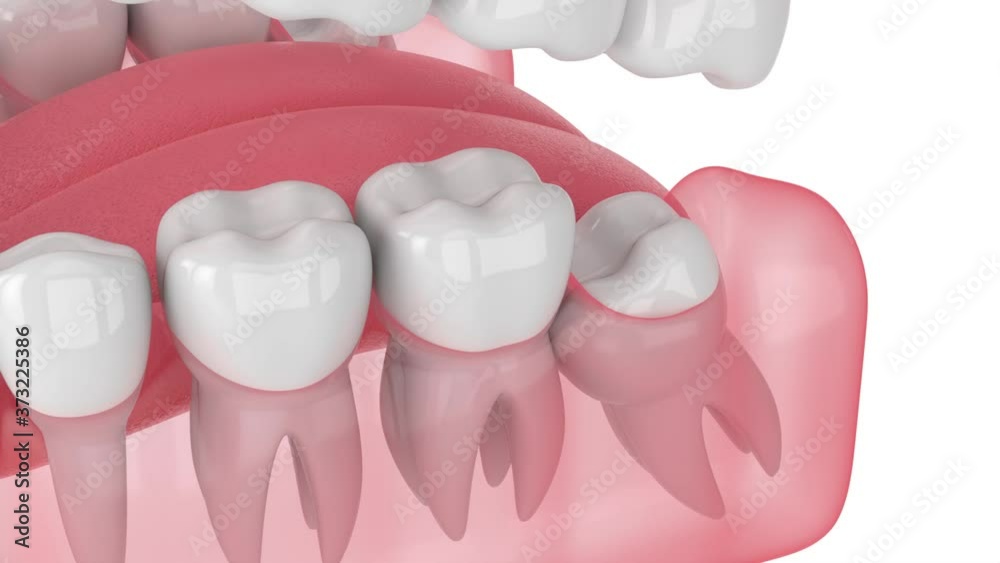 Jaw with mesial impacted wisdom tooth