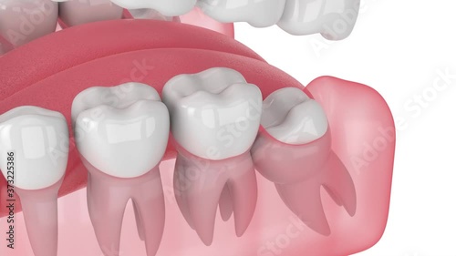 Jaw with mesial impacted wisdom tooth photo