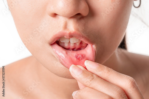 Asian women have aphthous ulcers on mouth on white background, selective focus. photo