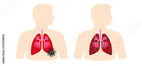 Stop coronavirus epidemic, bacteria cell. ( Covid-19 2019-nCoV, Covid-2019 ) Corona virus in China, Wuhan lockdown. Stay at home, stay safe. Social distancing Face mask. Self quarantine concept.