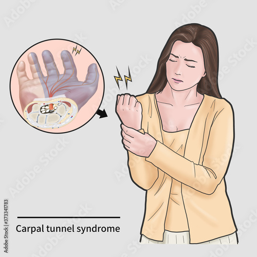 Women with carpal tunnel syndrome