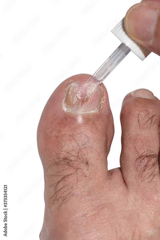 Hand applying antifungal polish to a big toe nail affected with Onychomycosis toe fungus. Stock