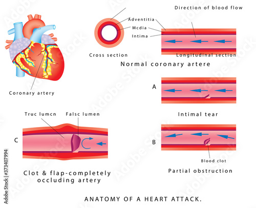 Heart attack. Anatomy of a heart attack. Heart attack and atherosclerosis. Blood vessel section with fatty deposit accumulation. Atherosclerosis progression till Stroke and Heart attack