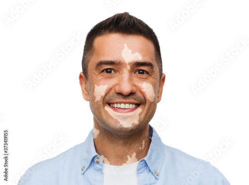 diversity, skin pigmentation and people concept - happy smiling man with vitiligo