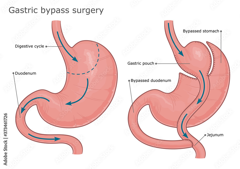 Gastric bypass surgery before and after. Vector illustration.  - obrazy, fototapety, plakaty 