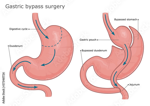 Gastric bypass surgery before and after. Vector illustration.  photo
