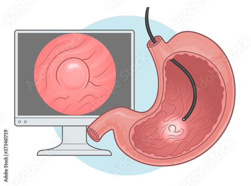 Gastroscopy procedure illustration. Diagnostics of gastric disease vector illustration. 