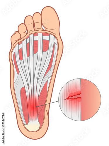 Plantar fasciitis illustration