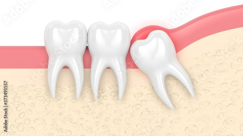 Wisdom mesial impaction with pericoronitis photo