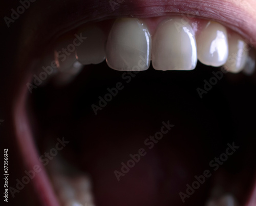 Dental detail: close up of teeth in an open mouth, crack on front tooth visible