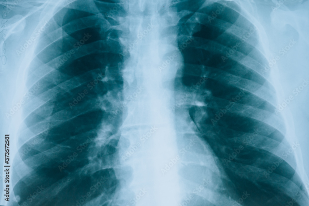 X-ray of lungs, fluorography. Medical scan of the lungs
X-ray of lungs, fluorography. Medical scan of the lungs