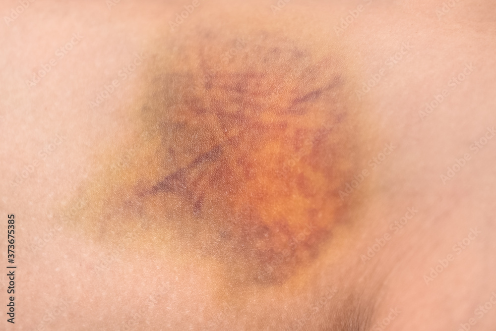 large bruise hematoma on the womans leg on the skin