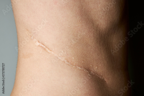 surgery scar after kidney pyelonephritis. after remove kidney operation. caucasian person close up over gray background