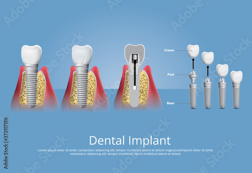 Human teeth and Dental implant Vector Illustration