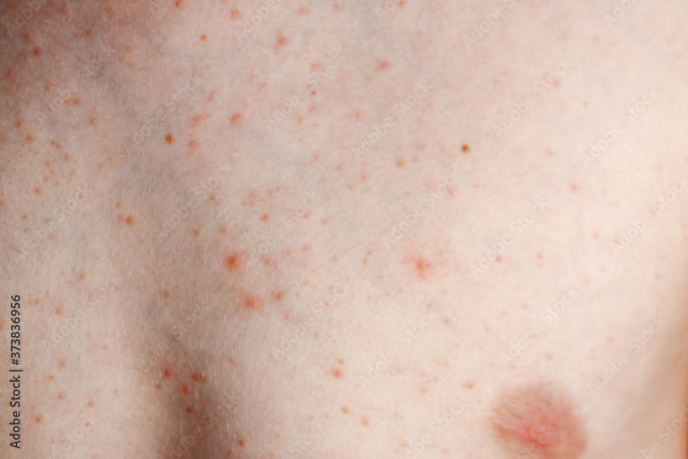 Fototapeta premium Close up image of a little boy's body suffering severe urticaria, nettle rash also called hives
