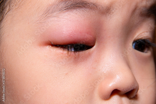 Close-up of a Asian child eye stye. Ophthalmic hordeolum disease. Selective focus. photo