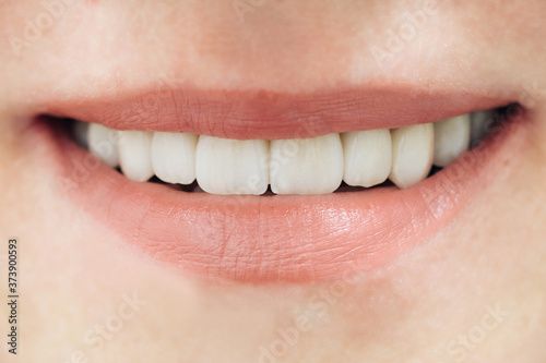 Beautiful female teeth macro zirconium. Closeup smile photo with zirconium artificial teeth. Zirconia bridge with porcelain.