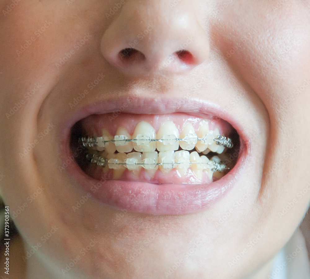 mujer joven muestra su bonita dentadura con un corrector dental para