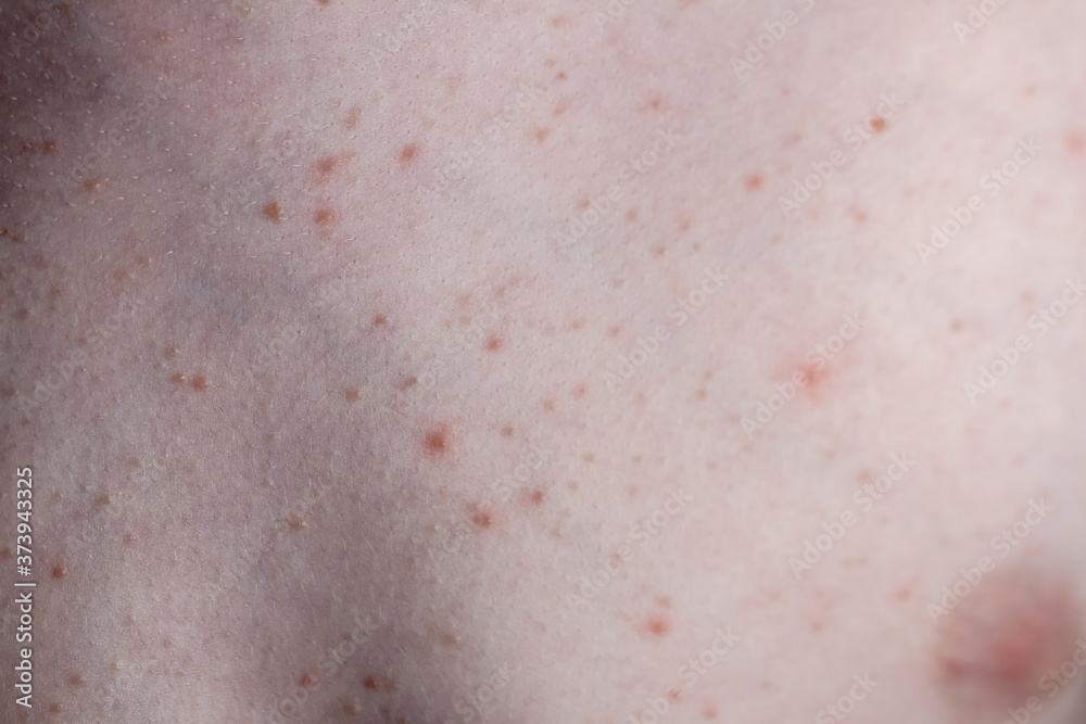 Close up image of a little boy's body suffering severe urticaria, nettle rash also called hives