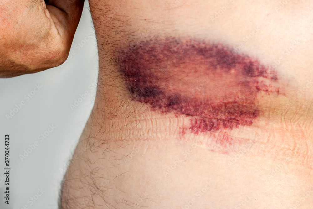 Large bruise on the man's body. Subcutaneous injury on human skin, painful blue bruise. Large bruise on the man's body. Subcutaneous injury on human skin, painful blue bruise.