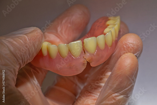 Konstfotografi Removable denture with cast reinforcement on hand in gloves