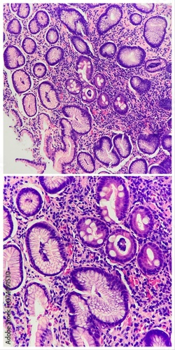 Gastric mucosa reveals focal intestinal metaplasia, photo under microscope, magnification 200x in the upper, magnification 400x in the lower photo