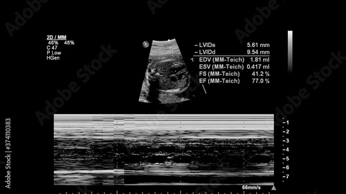 Ultrasound screen with fetal echocardiography.