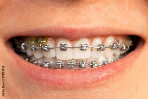 Problem of cleaning dental metal braces from food debris and dirt