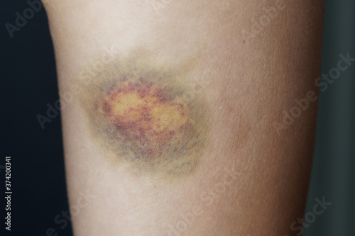 Close up. A large bruise on a woman's leg. photo