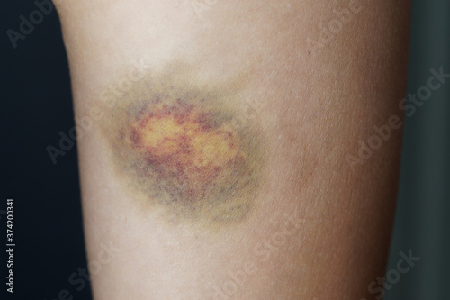 Close up. A large bruise on a woman's leg.