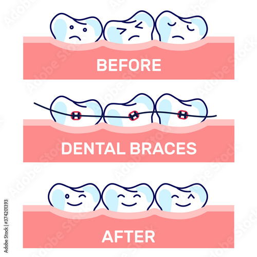 Cartoon kawaii funny teeth vector illustration, before and after brace correction. Concept of ortodontic treatment. Stages of dental alighment. photo