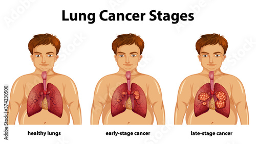 Informative illustration of lung cancer stages