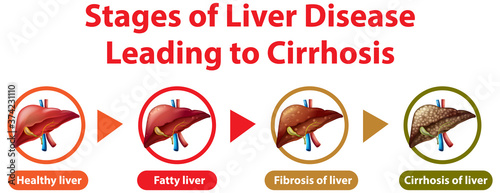 Stages of liver disease leading to Cirrhosis