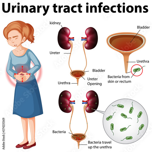 Informative illustration of urinary tract infections