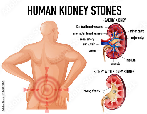 Comparison of healthy kidney and kidney with stones
