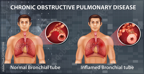 Chronic obstructive pulmonary disease
