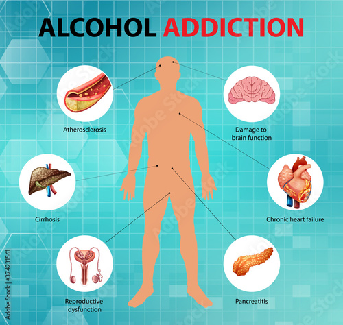 Alcohol addiction or alcoholism information infographic