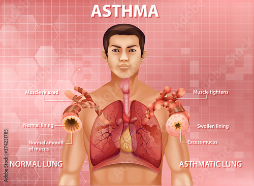 Human anatomy asthma diagram