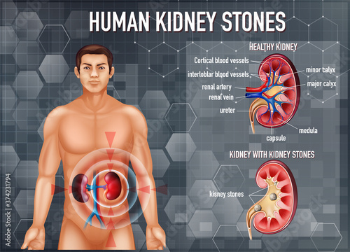 Comparison of healthy kidney and kidney with stones