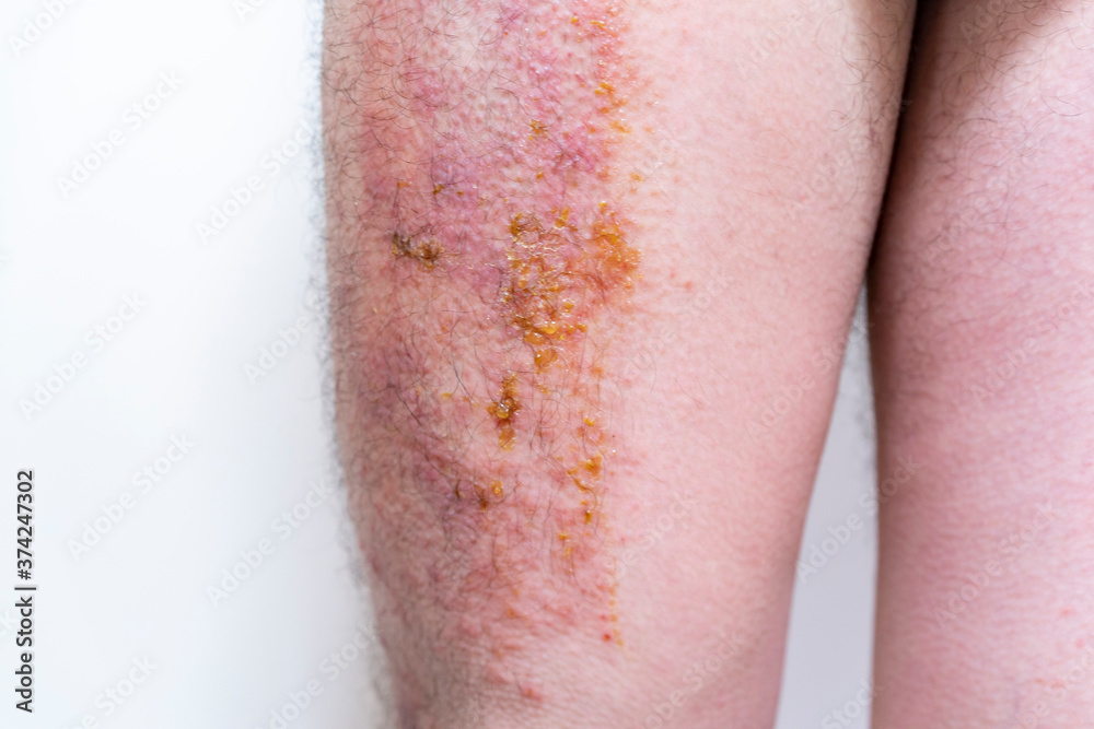 Fototapeta premium 膿の出ている重度の湿疹