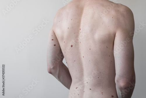 Male torso with a lot of moles,