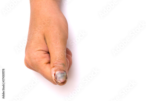 Injury, injury to the thumb, finger, on the hand. The damaged nail. hematoma