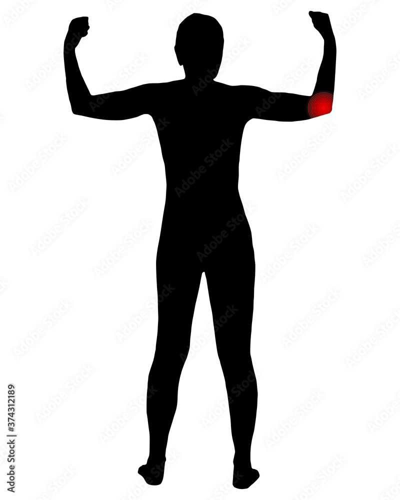 Fototapeta premium Rückansicht Frau mit Symbol für Ellbogenschmerzen