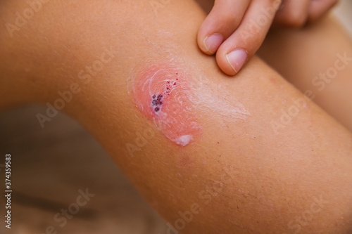 The child smears cream on the damaged skin on the leg. Dry skin and irritation. Allergic reactions.