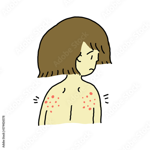 Woman with eczema on her back