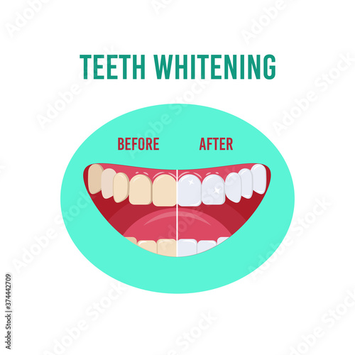 Before and after teeth whitening. Vector illustration isolated on a white background