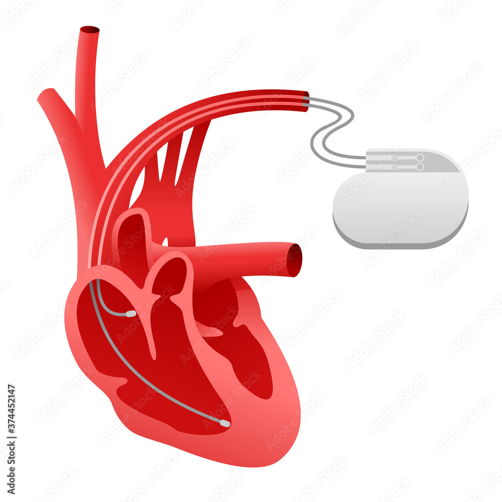 Vecteur Stock Pacemaker Cardio Stimulator Icon Heart Implant